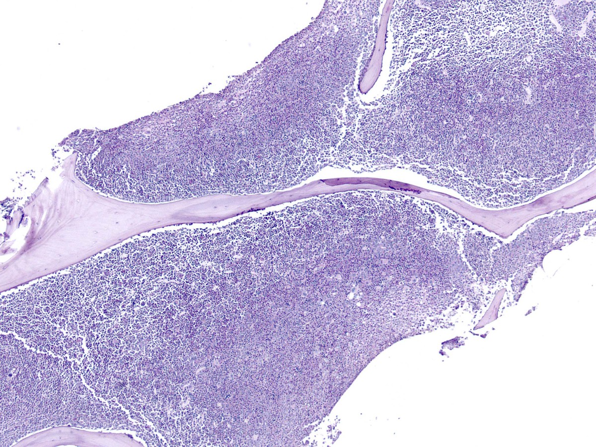2011 bone marrow biopsy, low power